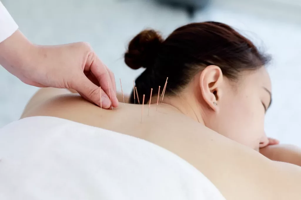 Cost Of Acupuncture Services in Dubai