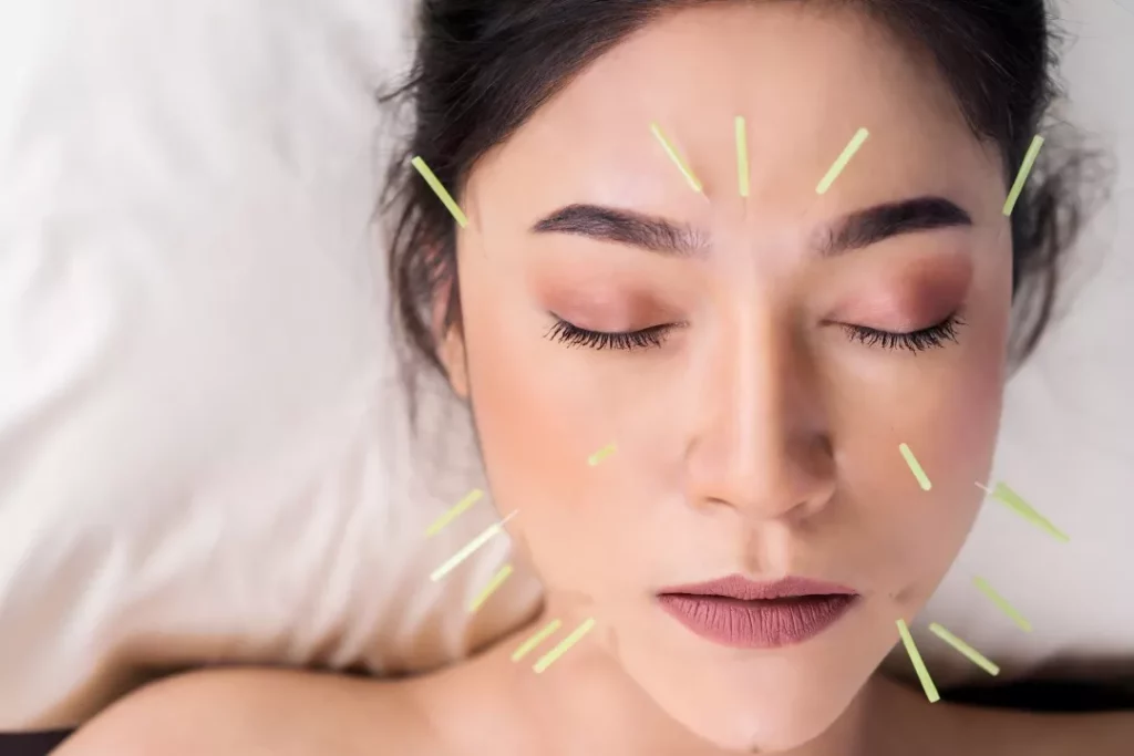 Does Acupuncture Hurt?