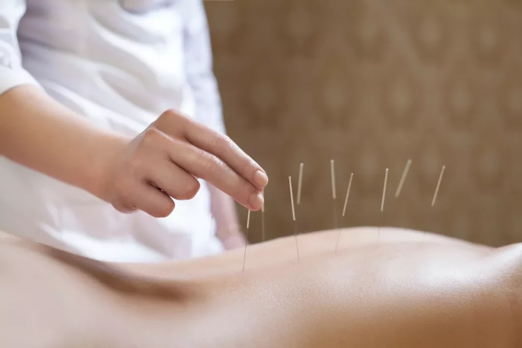 Who Can Provide Acupuncture?
