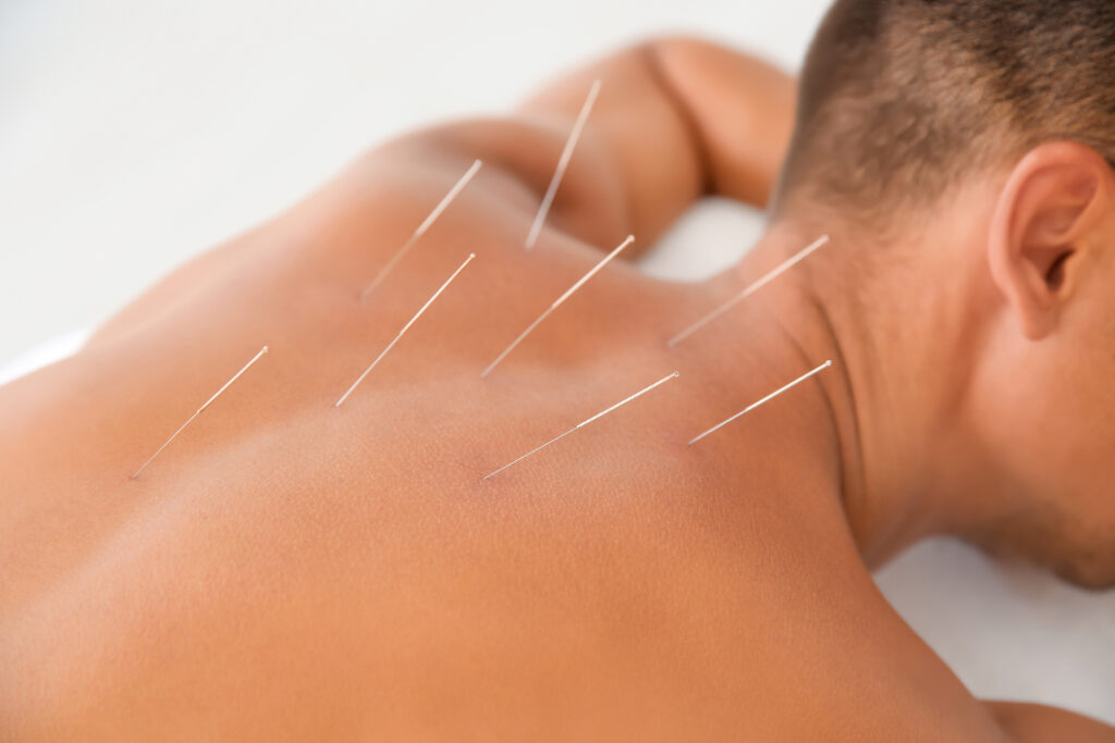 In What Way Does Acupuncture Help?