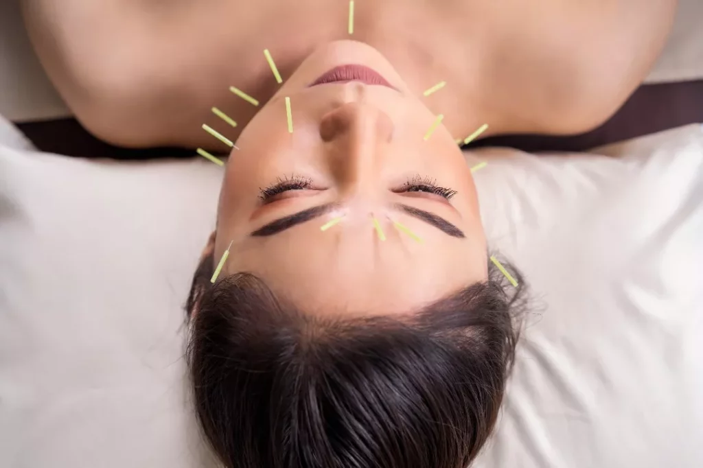 Where Acupuncture Needles are Placed? Does Acupuncture Hurts?