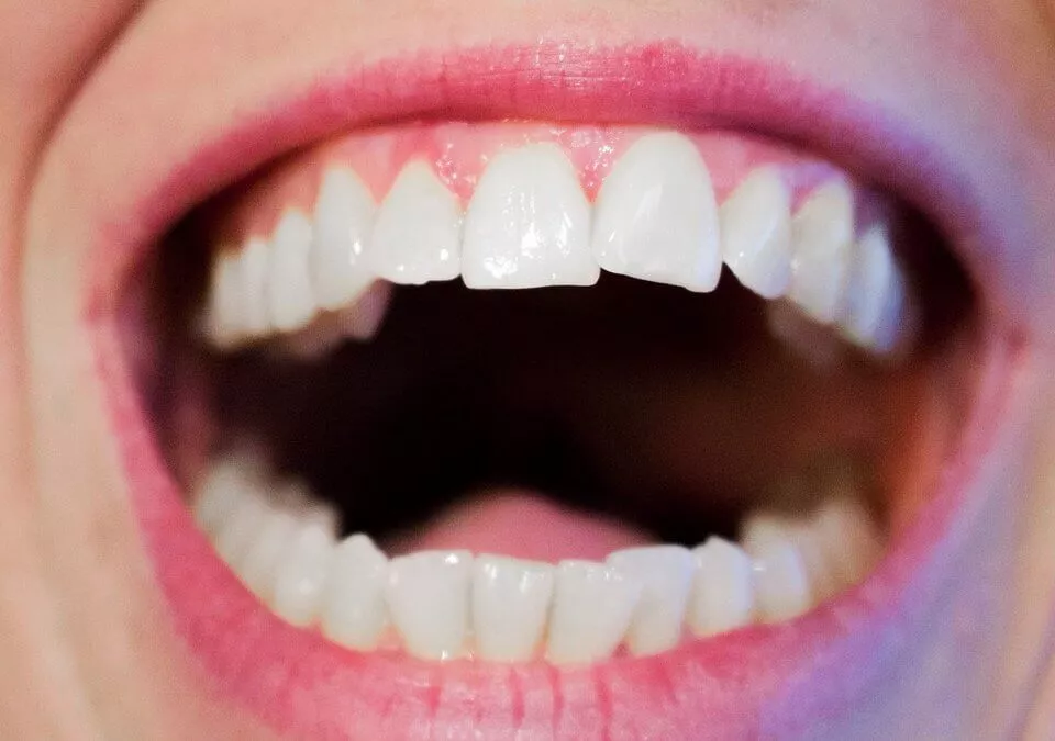 crooked teeth repair through veneers