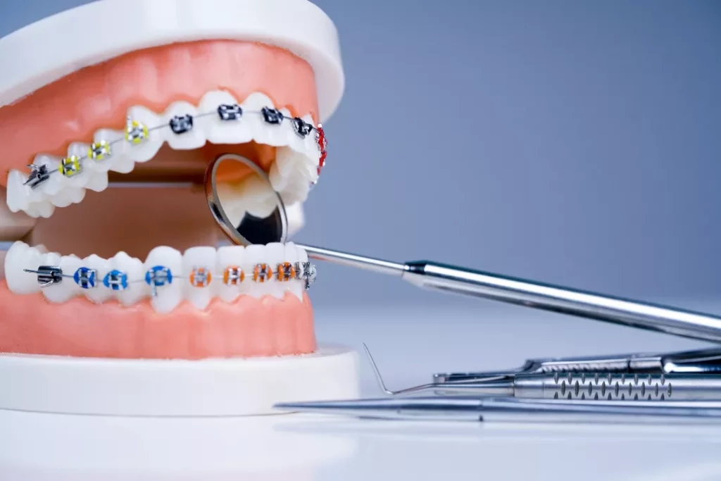 Can Orthodontists Remove Wisdom Teeth Or Do Filling?