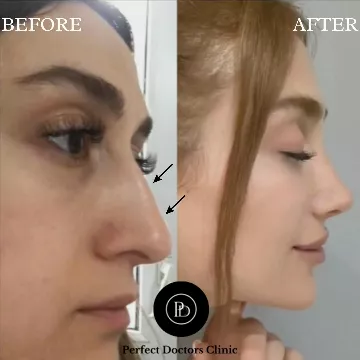 Rhinoplasty surgeon before & after