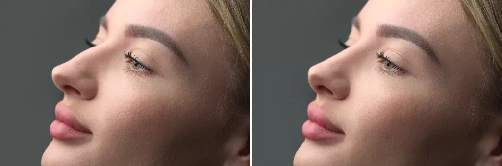 Rhinoplasty in Dubai A guide to surgery advantage and cost​