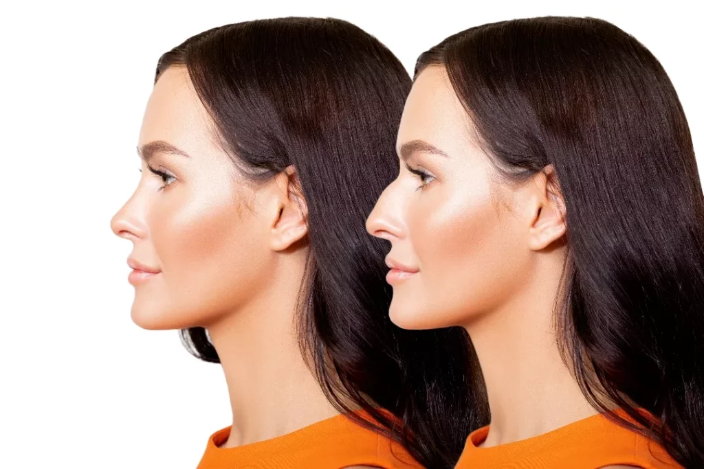 Can Rhinoplasty Change Your Face?