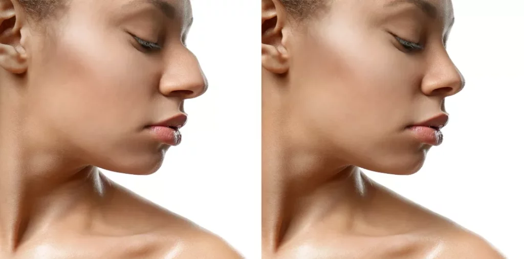 Will You Look Better After Rhinoplasty?