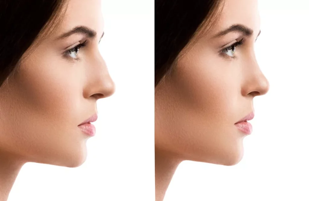 What Are The Healthy Benefits Of A Rhinoplasty?