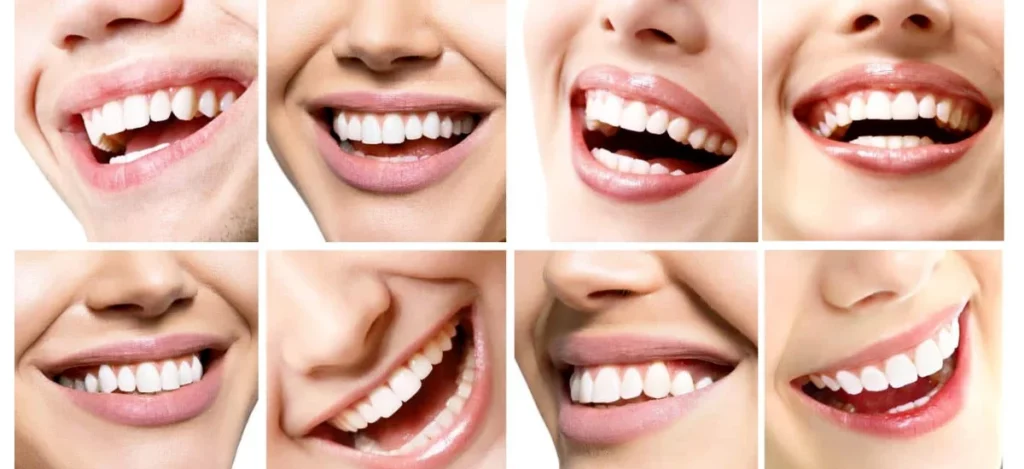 types of best veneers in Dubai