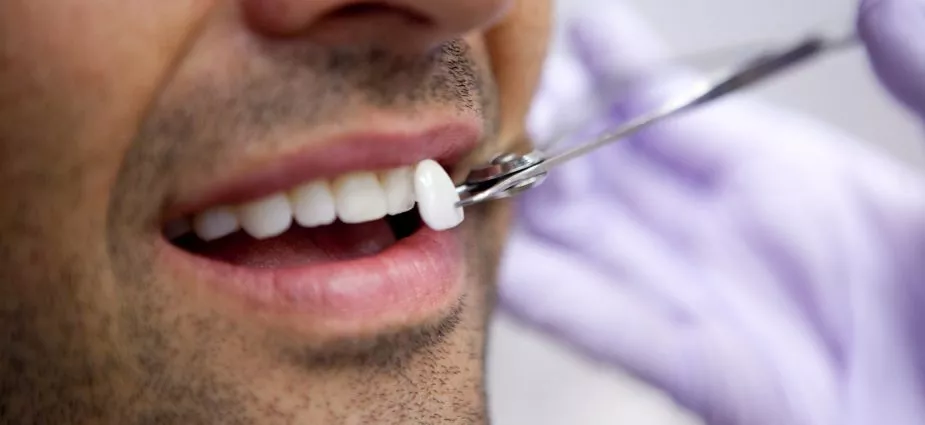 dental veneers in Dubai for best teethes