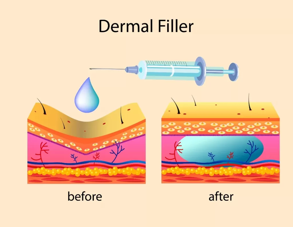 How Does Dermal Filler Work On The Face?​