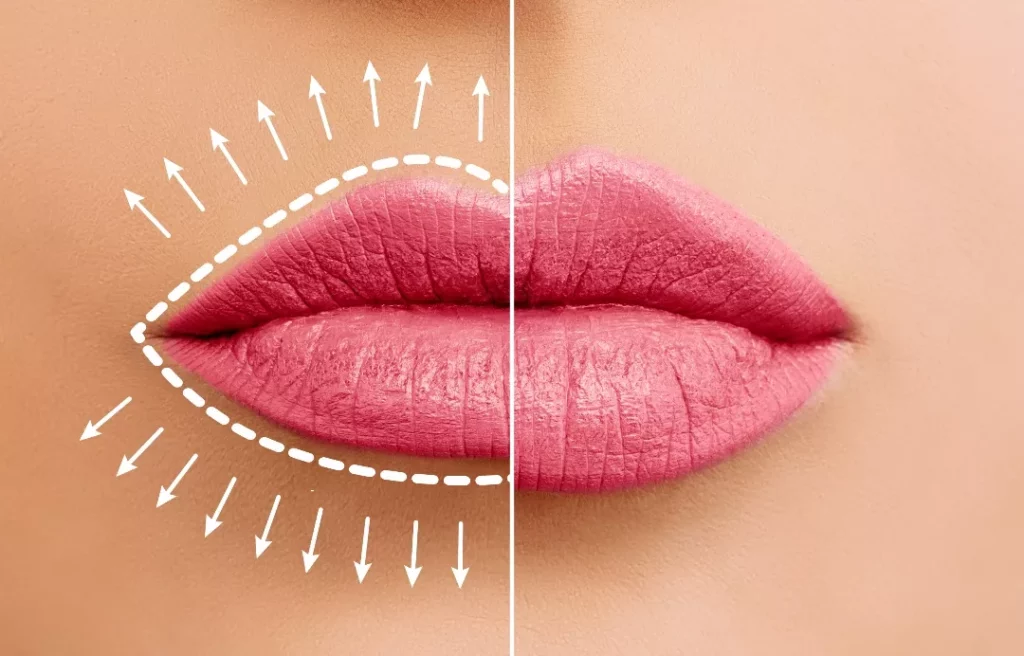 Efficacy of dermal fillers for lips