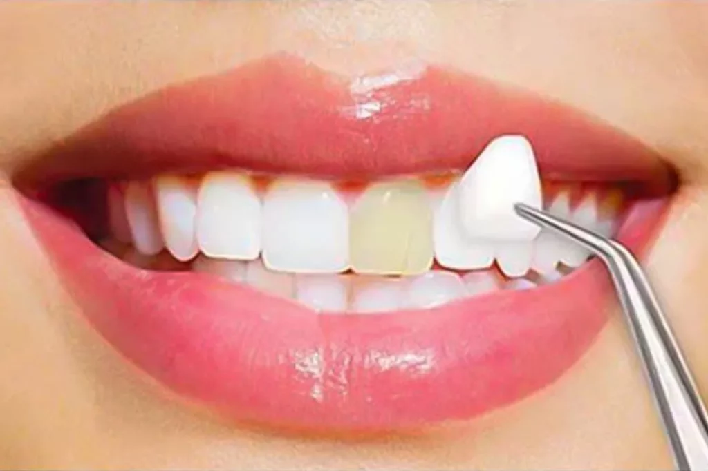 porcelain veneers in Dubai for best teeth