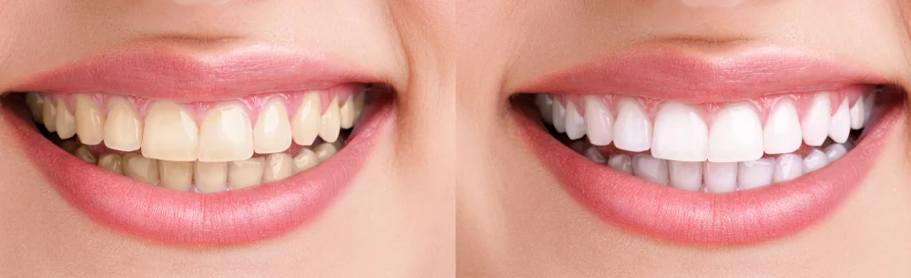before and after procedure of teeth showing veneer treatment