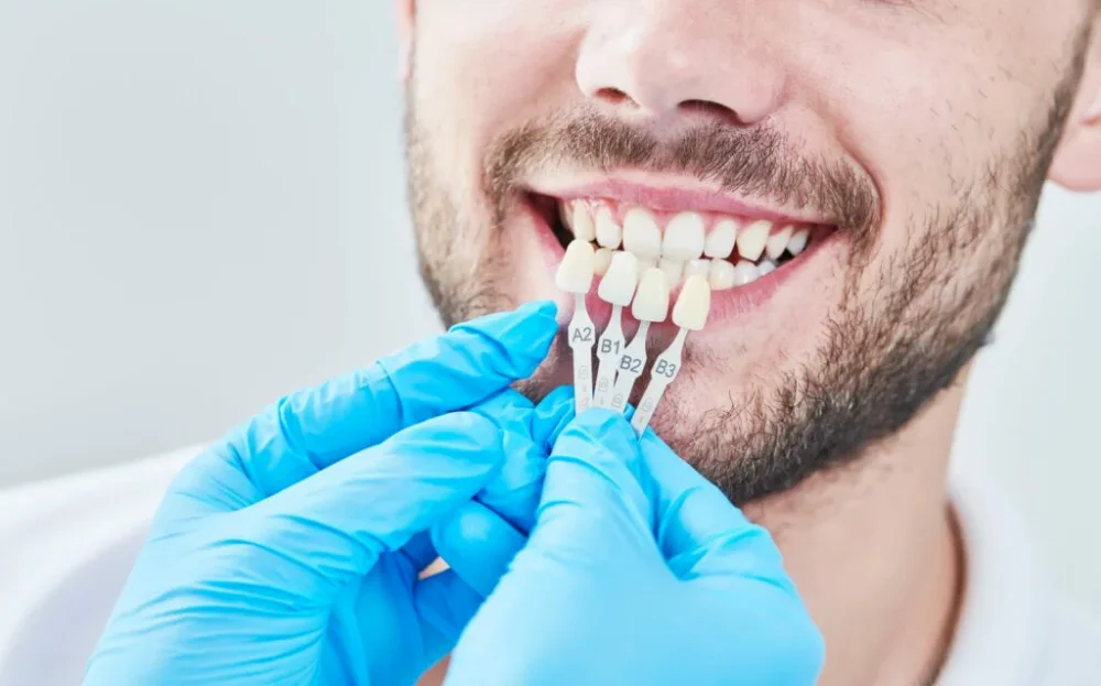 Signs for veneers replacement
